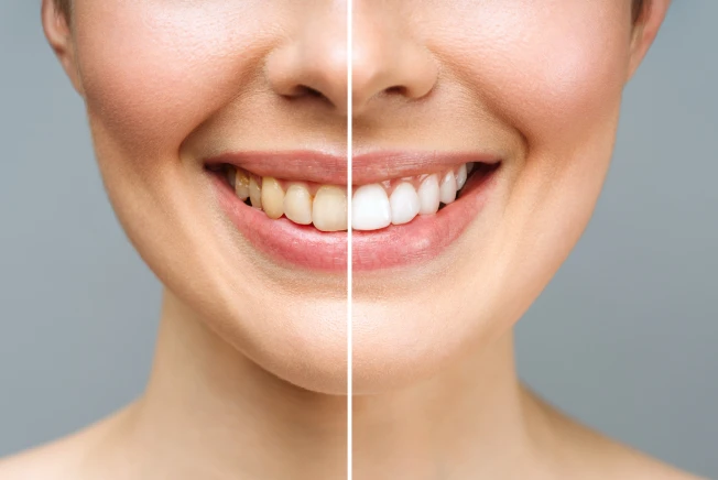 Clareamento dental