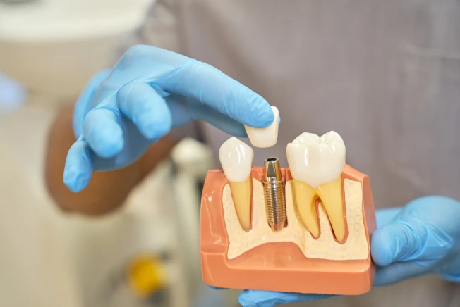 Implantes dentarios